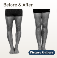 Limb Lengthening before and after photos